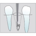 Freza chirurgicala C560 - imagine 3