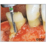 Freza chirurgicala GSD1 - imagine 3