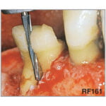 Freza chirurgicala RF161 - imagine 3