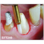 Freza gingivectomie STT249 - imagine 3