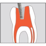 Freza diamantata endo 802L - imagine 3